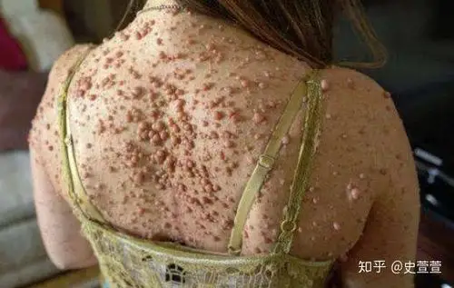 扁平疣是什么得了扁平疣怎么办