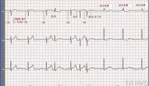 心电图学习20071109窦性心动过缓室性逸搏心律伴干扰性房室脱节房性