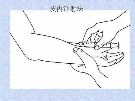 注射位置选取一般在前臂掌侧下段避开静脉处,小角度近似平行进针,当