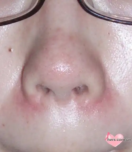 鼻翼两侧发红 如图