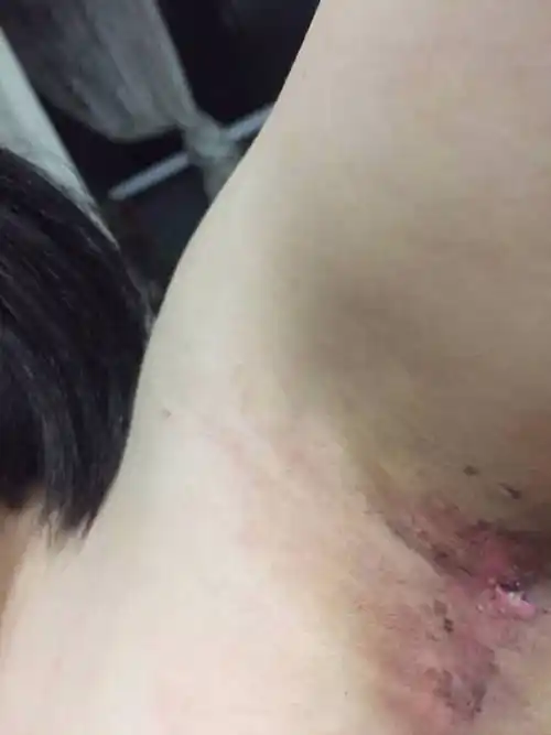 请问腋臭手术第十天变这样了该怎么办