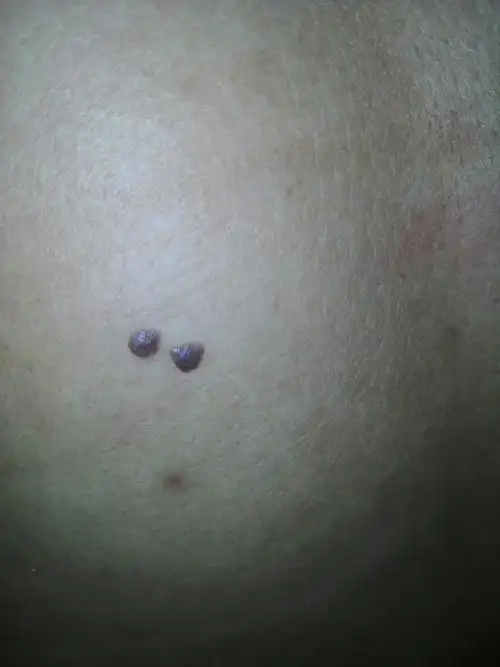 后背突然长出来两个黑痣,不疼不痒,请问这是怎么回事,不会是皮肤癌吧