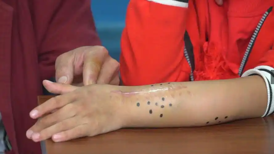 8岁女孩被血管瘤折磨一生,母亲出走,父亲仍抱希望寻求转机