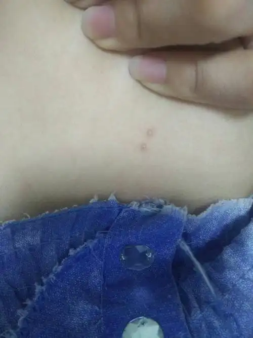 乳房长了两颗疙瘩很久了不痛不痒的怎么回事呢