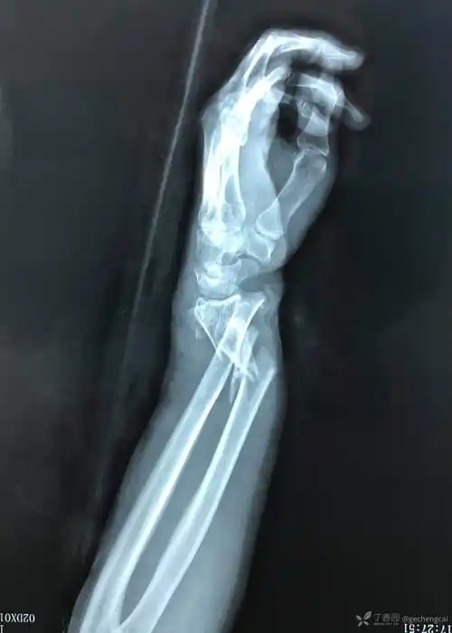 开放性尺桡骨远端粉碎性骨折