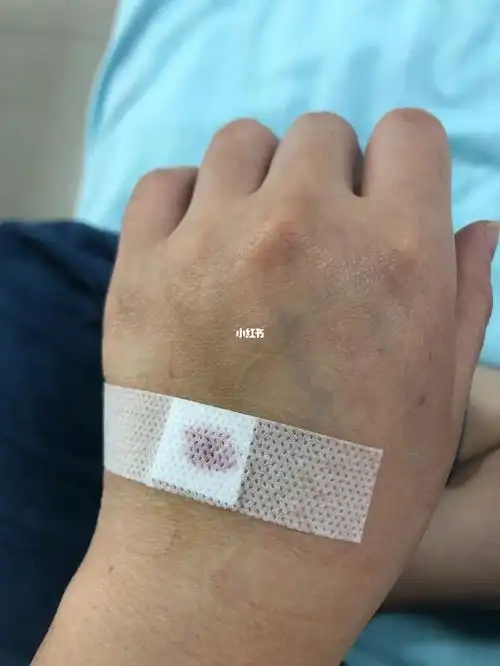 现在拔针流血都习惯了