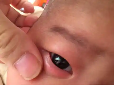 三个月宝宝下眼睑很红,有时还有小疹子,有图