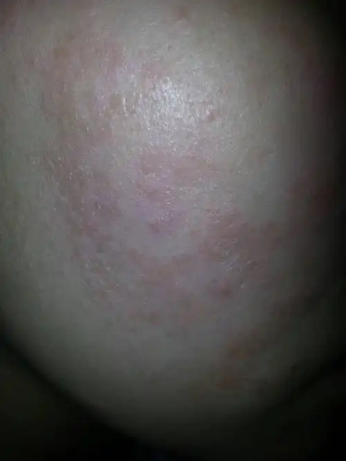 脸上长红癣,干疼,起皮是怎么回事?如何治疗?我怀孕7个月