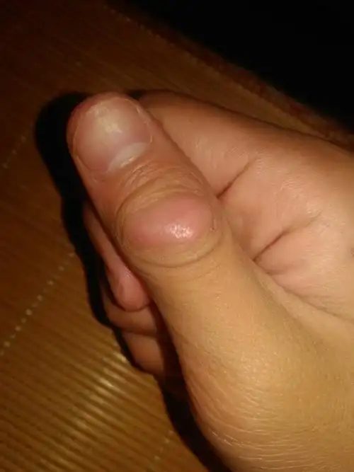 大拇指上长了个包