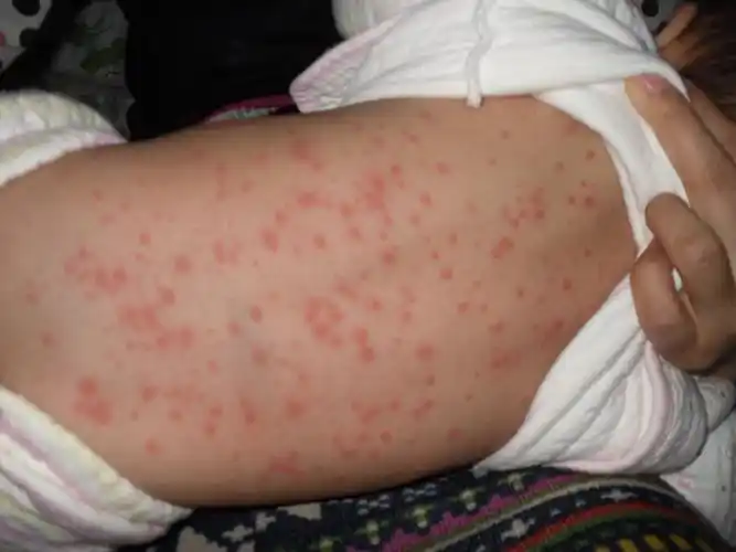 9个半月宝宝,身上出现一大片红疙瘩,请帮忙看下是什么?