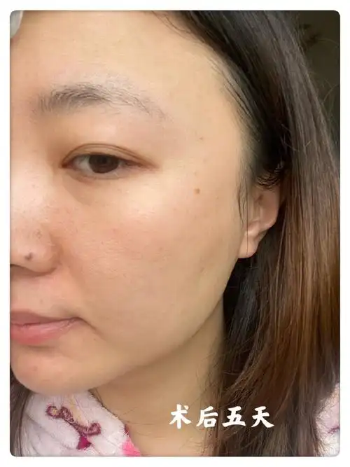 现在是距离我做了凝光中胚层_圈子-新氧美容整形