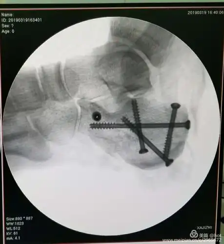 跟骨骨折经皮撬拨复位空心螺钉内固定术