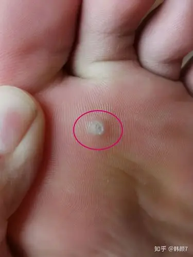 怎么治脚上跖疣(已治愈 历时七个月)