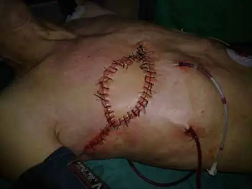 乳腺癌手术后乳房缝合图片