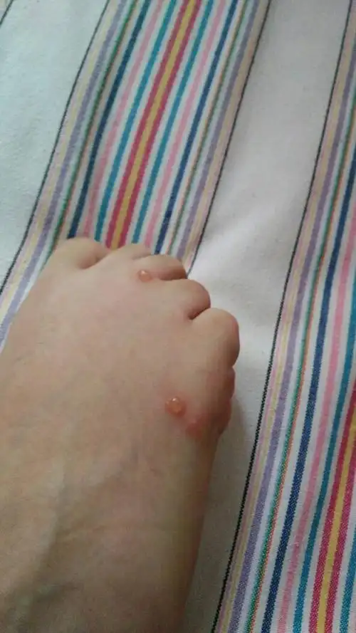 请问这是什么虫子咬的.每到这个季节身上腿上脚掌就会有这种伤口.