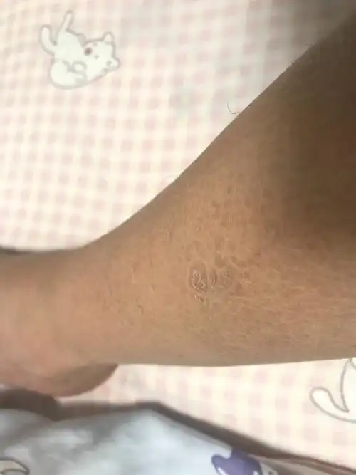 有处理的方法么?平时也不痒不痛,就是感觉跟粗糙,老是褪皮