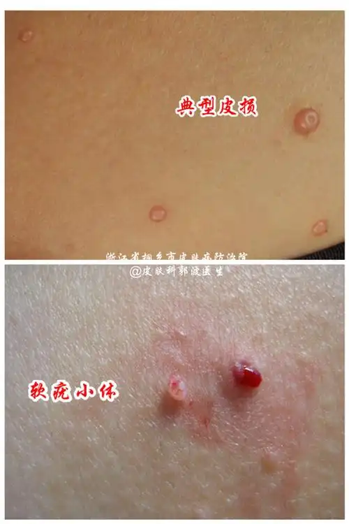 传染性软疣_疾病介绍_治疗方法_传染 - 好大夫在线