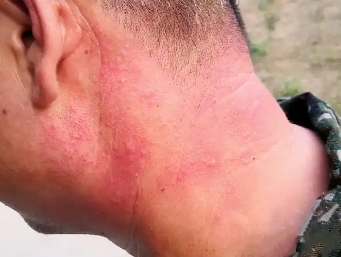 痱子怎么快速消除止痒小妙招(痱子成片成片地长,怎么都消不掉,权威