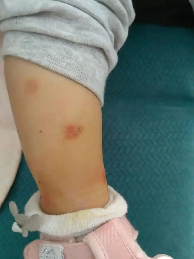 线上线下都说是湿疹里面的丘疹性荨麻疹,跟蚊虫叮 - 抖音