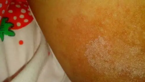 大腿内侧出现这种问题是什么皮肤病