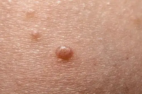 身上长这3种小疙瘩的,说明已感染了hpv!快看你有没有!