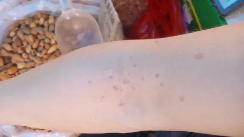 也不知道是不是老人斑或晒斑,怎样去区别和治疗?