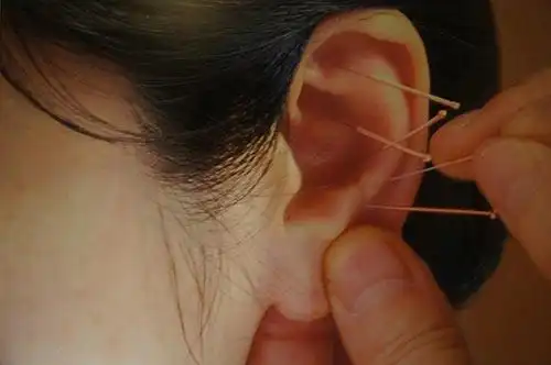耳穴疗法
