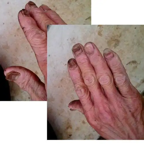 请看【图片】这个手指甲是怎么回事.