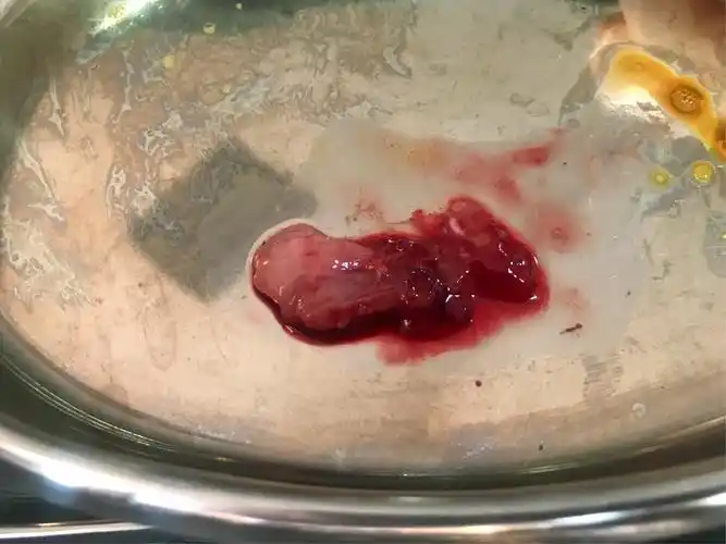 不识庐山真面目,只缘身在此山中「宫颈内口息肉脱垂至宫颈外口」