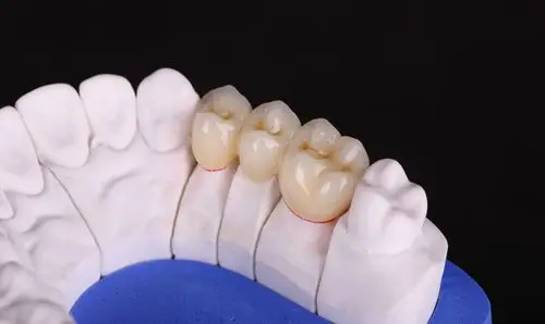 爱尔创全瓷,全锆