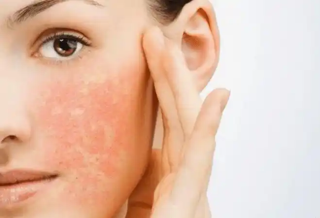 皮肤干痒脱屑脸易红多数是敏感肌了