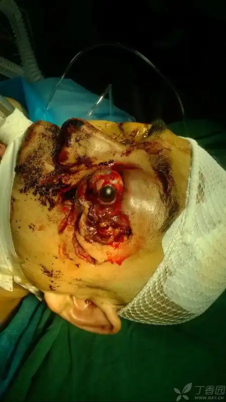 【讨论】这例眼球脱臼,视神经撕脱,若不摘除又会如何?