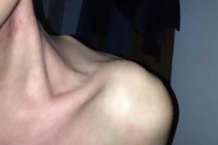 肩膀上骨头凸起怎么回事图片