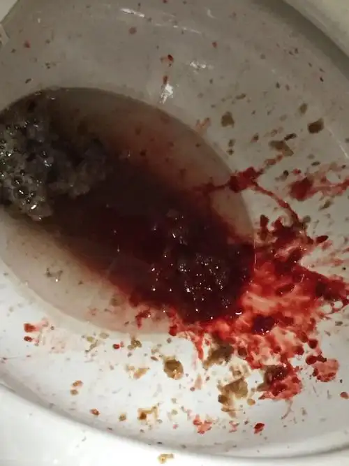 孕妇15周,今天吃的面条和少量的油饼,平时也有呕吐反应,但今天晚上