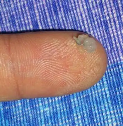 病情描述及疑问:您好,为什么我精液里面有如图所示的软软果冻状固体