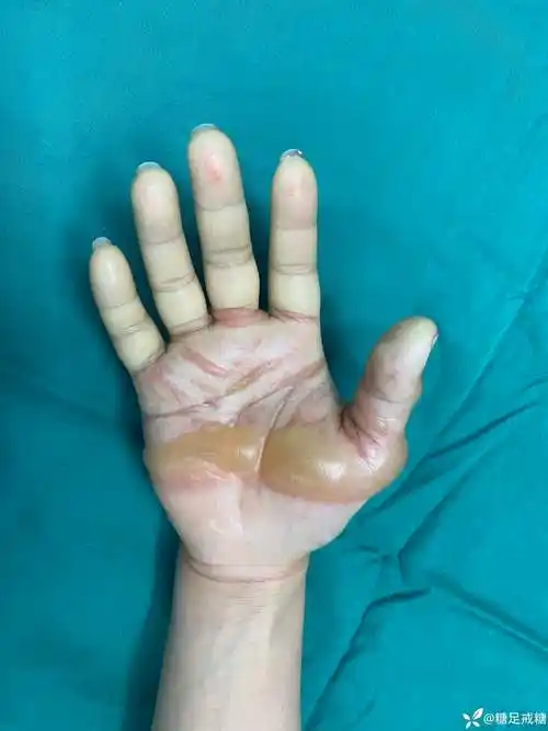 这种烫伤你见过吗