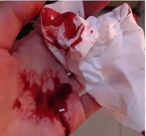 90后孕妇顺产生下宝宝后突然大口吐血医生双手发抖