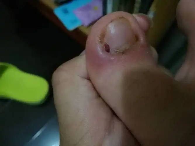 甲沟炎去医院剪过了,但是现在又流脓了,而且还肿起来发紫