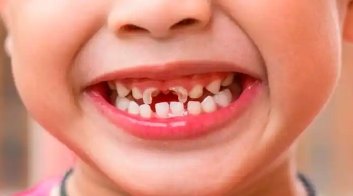 儿童龅牙,儿童大龅牙-图片大观-奇异网