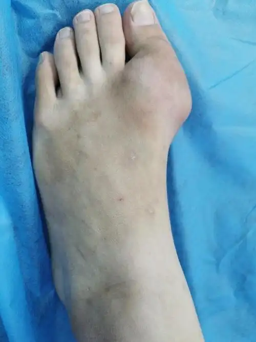 慈惠医院纪实25岁小伙痛风双脚大拇指长满石头饮食习惯惹的祸