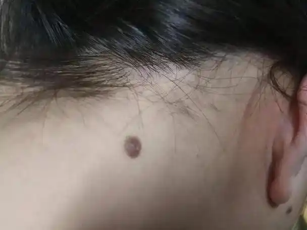 身上的痣有好坏?如果"黑痣"长在这3个部位,多留意