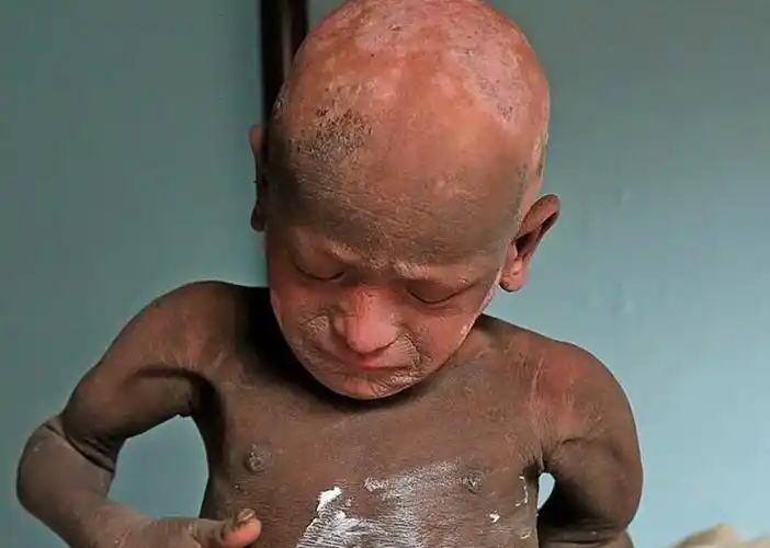 做父母!火棉胶样婴儿能痊愈吗"真凭实据"-第2张图片-凯飞博客