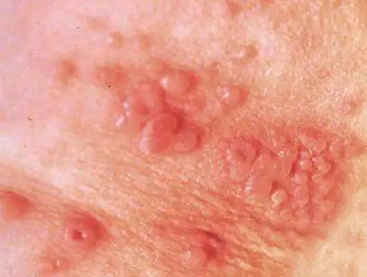 淋病的症状 (27)