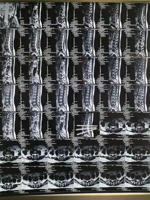 腰椎核磁共振提示腰5/骶1椎间盘脱出