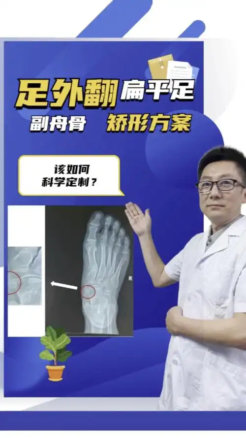 育儿副舟骨足外翻扁平足怎样选择矫形方案最合理