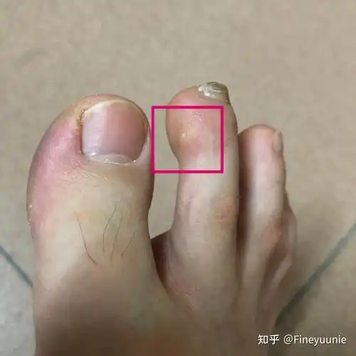 脚趾上长透明疙瘩中心点像针刺一样的形状