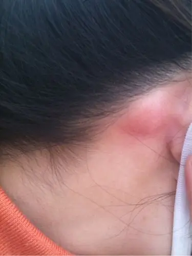 耳朵后起了个大硬包,过几个小时就下去了.怎么回事呀?