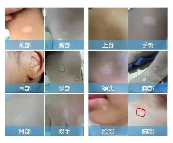 白癜风早期的白斑数目不是很多,面积也不大,一般的话是呈绿豆或者硬币