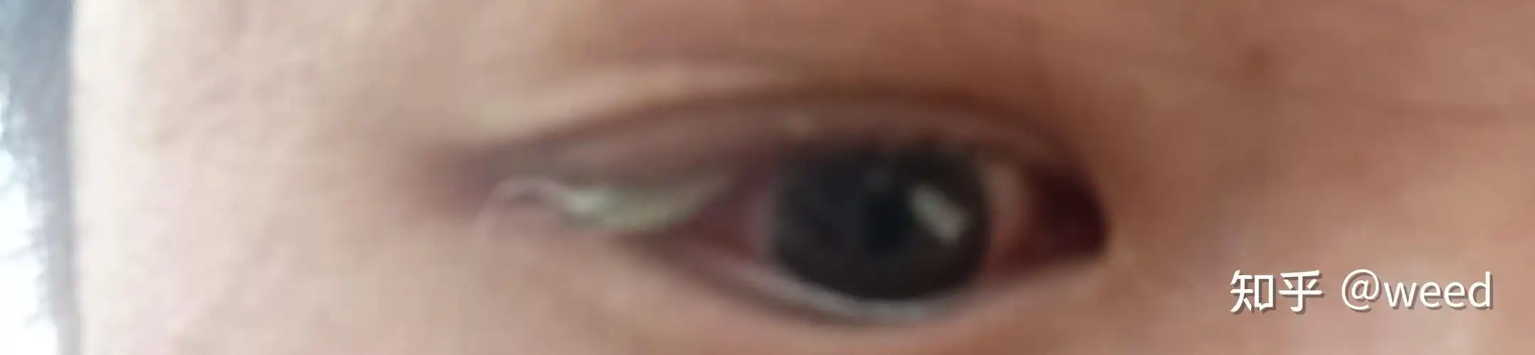 我眼睛里长了皮样脂肪瘤和大家分享一下我从检查到手术自己术后恢复的