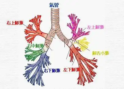支气管扩张反复咳痰咳不净怎么办